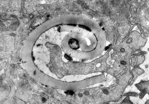M,43y. | blood - degraded Candida (bone marrow suppression) M,43y. | blood - degraded Candida (bone marrow suppression)